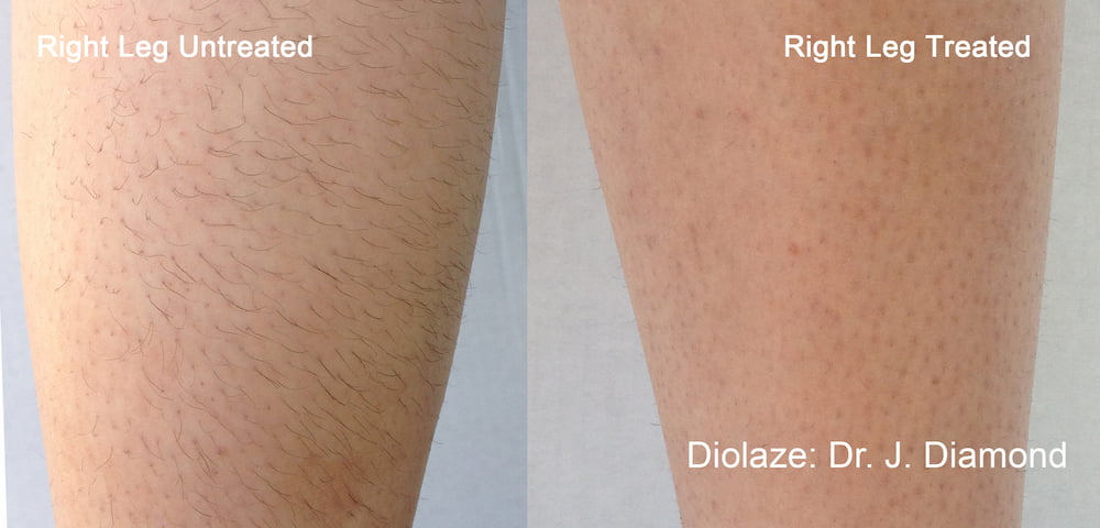 Laser epilation hair removal on legs before and after