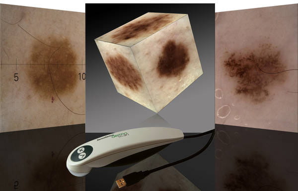 Vyšetření kožních znamének 3D dermatoskopem