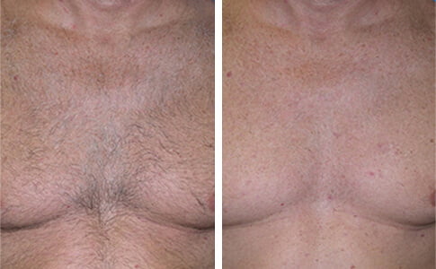 Laserová epilace odstranění chloupků na hrudníku před a po