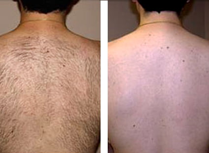 Laserová epilace odstranění chloupků na zádech před a po