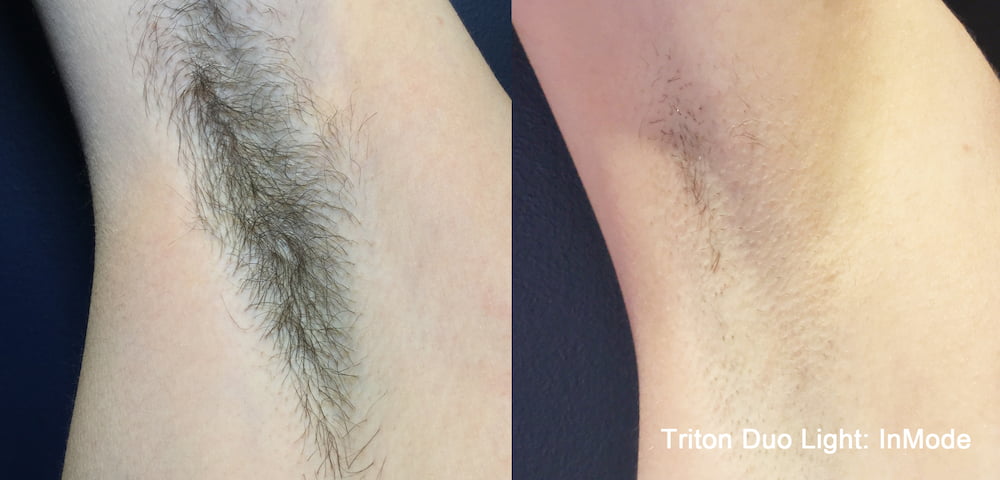 Laser epilation hair removal of the armpit before and after