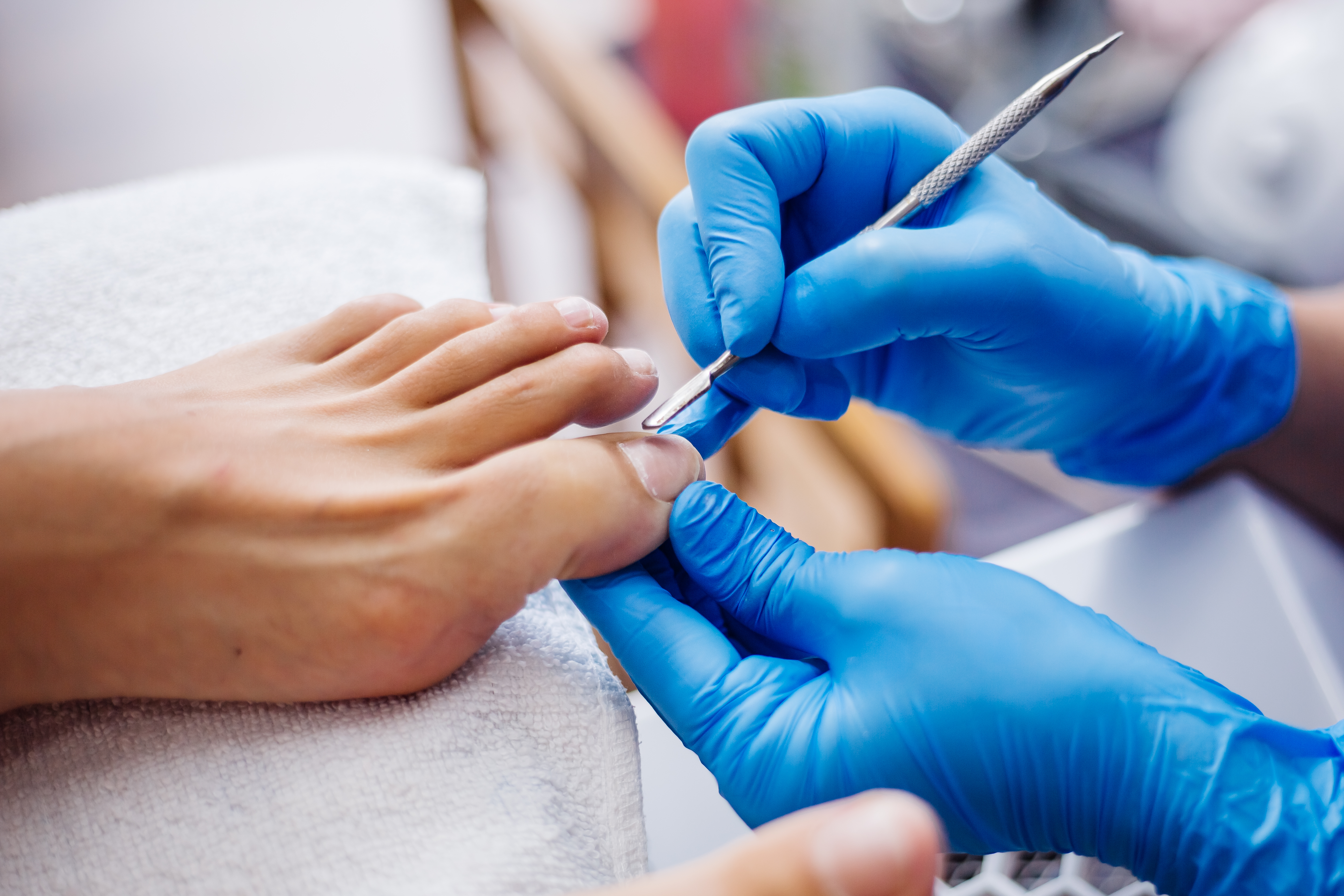 The Vandenbos procedure revolutionizes the problem of ingrown nails! - Fotka